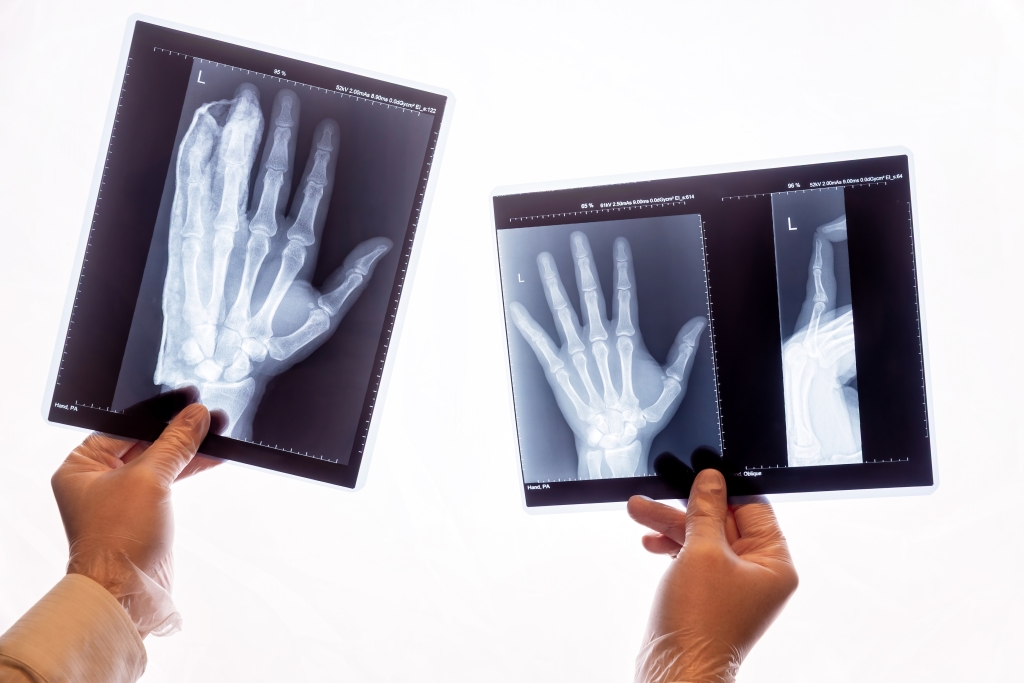 X-ray films showing a human hand